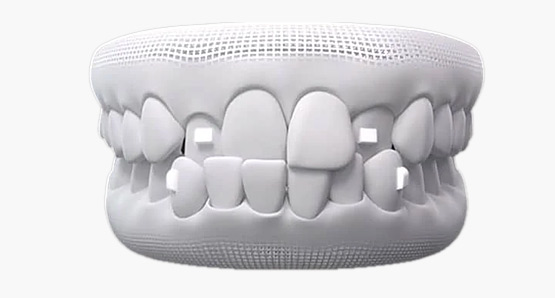 invisalign attachmenty