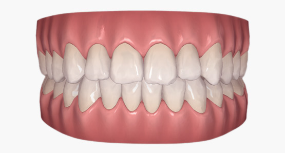 wirtulany plan leczenia invisalign