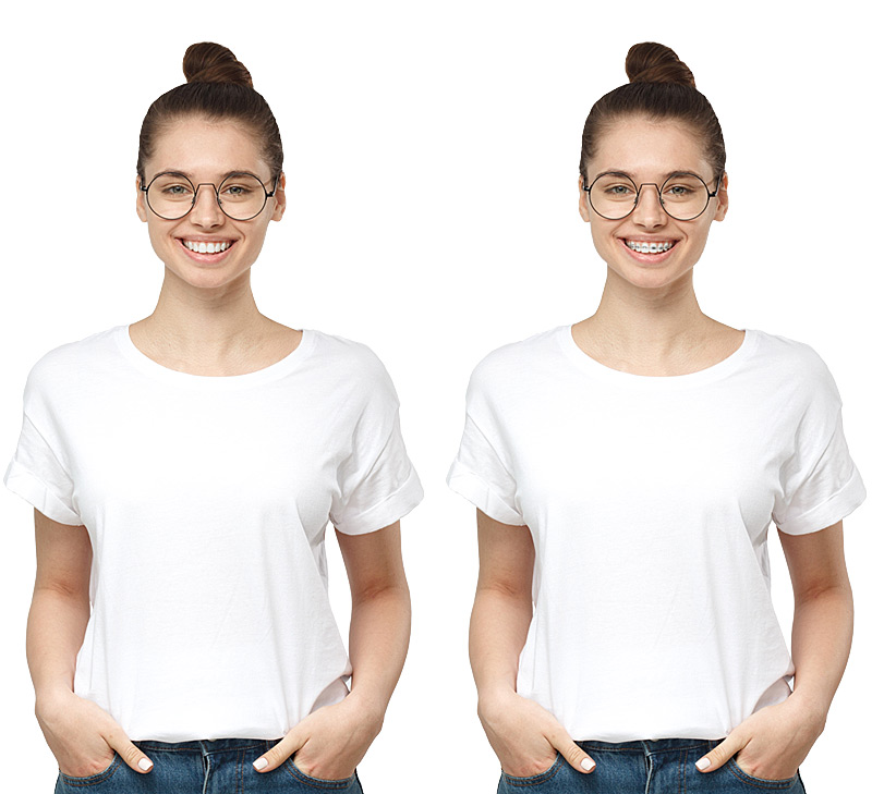 system invisalign katowice