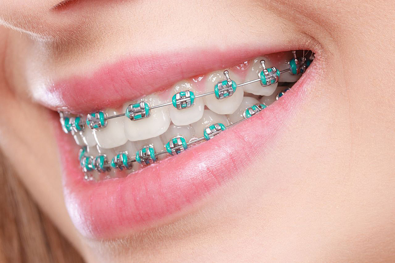 aparat ortodontyczny katowice